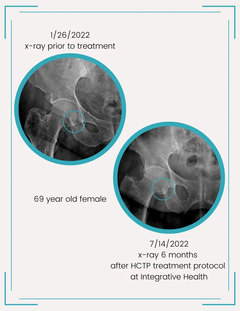 hip xray